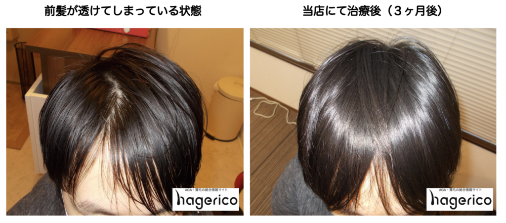 男性の前髪がスカスカ状態 すだれ状に生え際が薄くなる原因と対策とは Hagerico
