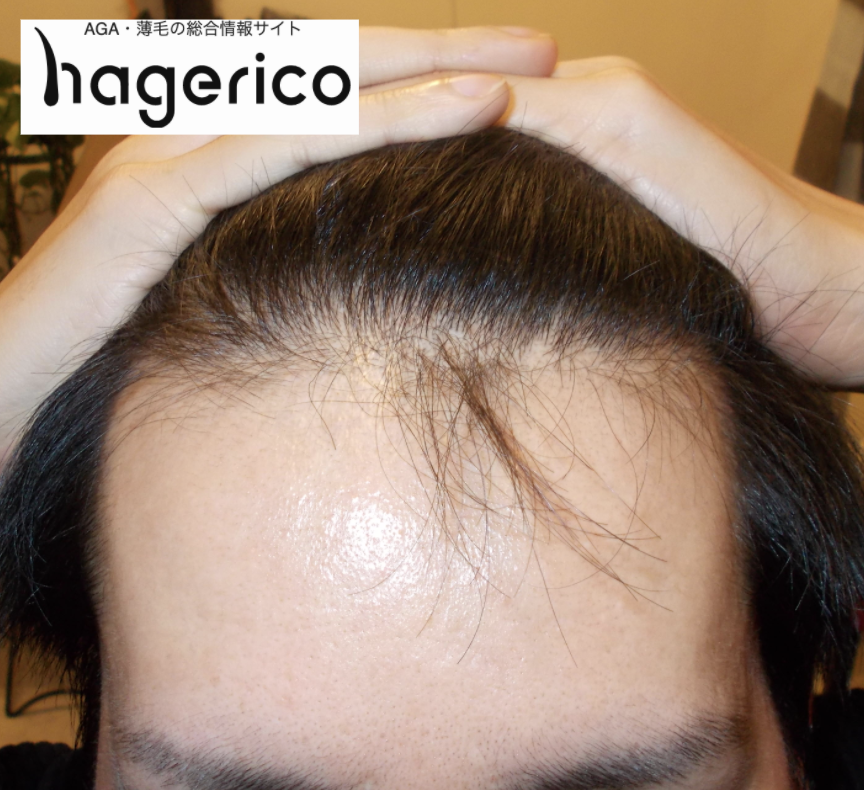 どこからがm字ハゲ 生え際の後退しているか判断する基準とは Hagerico