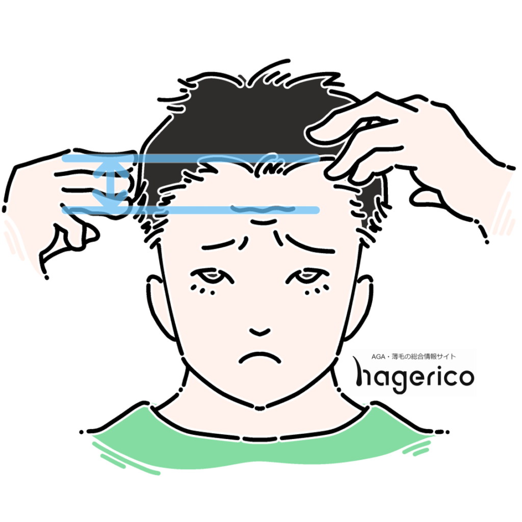 男性の前髪がスカスカ状態 すだれ状に生え際が薄くなる原因と対策とは Hagerico