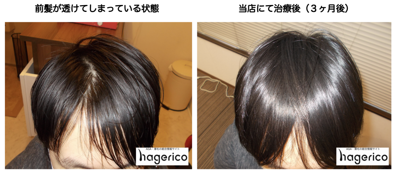 男性の前髪がスカスカ状態・すだれ状に生え際が薄くなる原因と対策とは？ hagerico