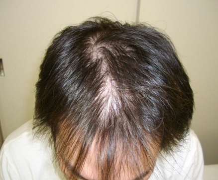 男性の前髪がスカスカ状態 すだれ状に生え際が薄くなる原因と対策とは Hagerico スーパースカルプ発毛センター