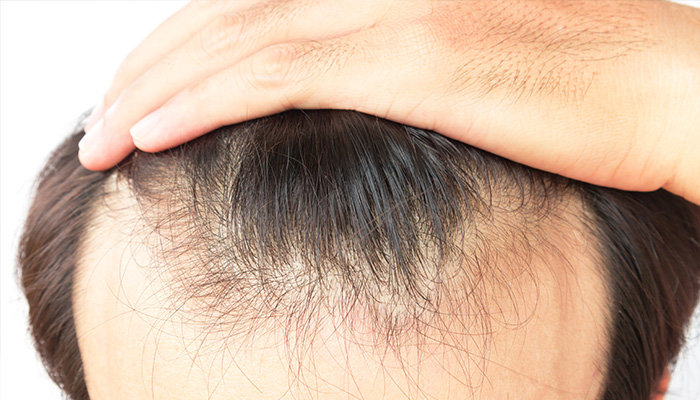 男性の M字ハゲ を改善する方法や前髪が薄毛になる原因を解説 Hagerico スーパースカルプ発毛センター