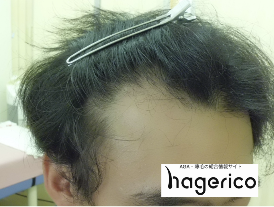 M字ハゲ 基準 写真