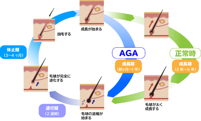 AGA　ヘアサイクル　毛周期