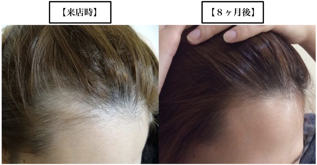 女性でもm字ハゲになる 前髪が薄いと悩む女性の薄毛の原因と対策とは Hagerico スーパースカルプ発毛センター