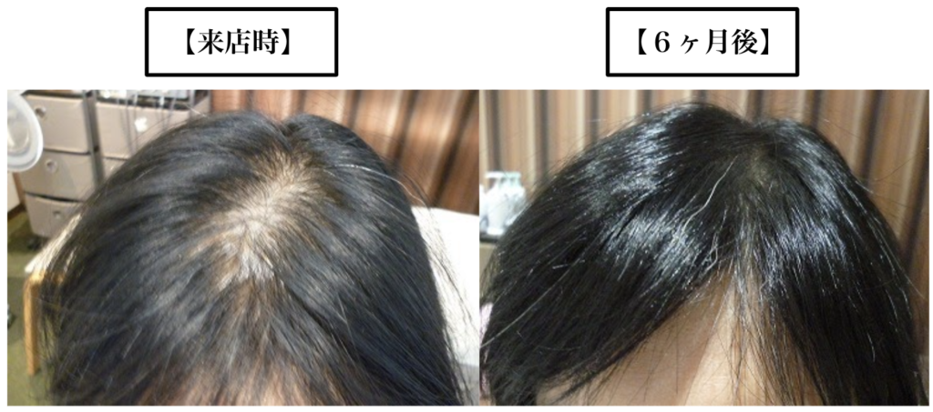 女性でもm字ハゲになる 前髪が薄いと悩む女性の薄毛の原因と対策とは Hagerico スーパースカルプ発毛センター