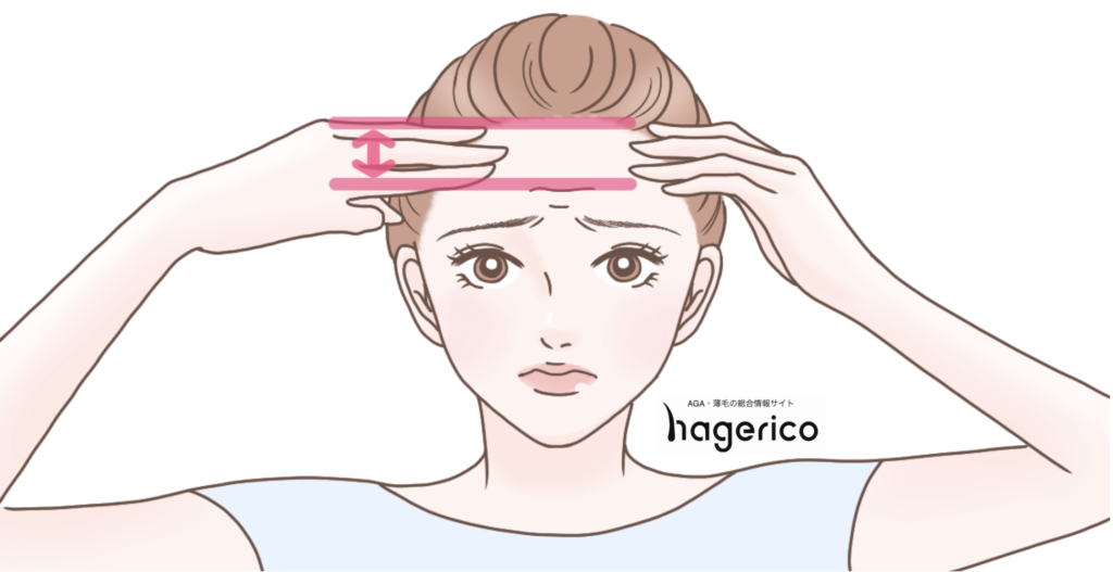 女性でもm字ハゲになる 前髪が薄いと悩む女性の薄毛の原因と対策とは Hagerico スーパースカルプ発毛センター