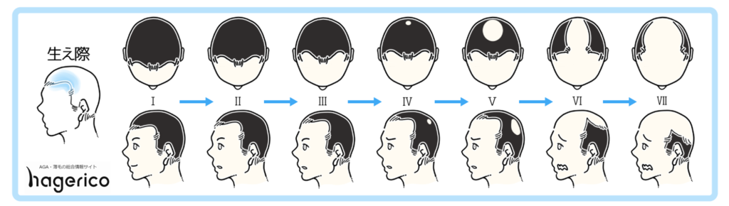 高校生でハゲてきた 10代でagaになる原因と未成年で出来る薄毛対策とは Hagerico