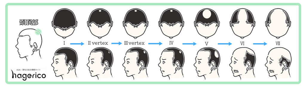 高校生でハゲてきた 10代でagaになる原因と未成年で出来る薄毛対策とは Hagerico スーパースカルプ発毛センター