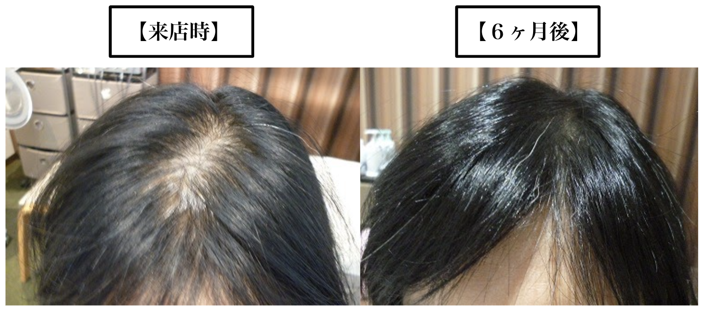 女性でもM字ハゲになる？前髪が薄いと悩む女性の薄毛の原因と対策とは？ hagerico