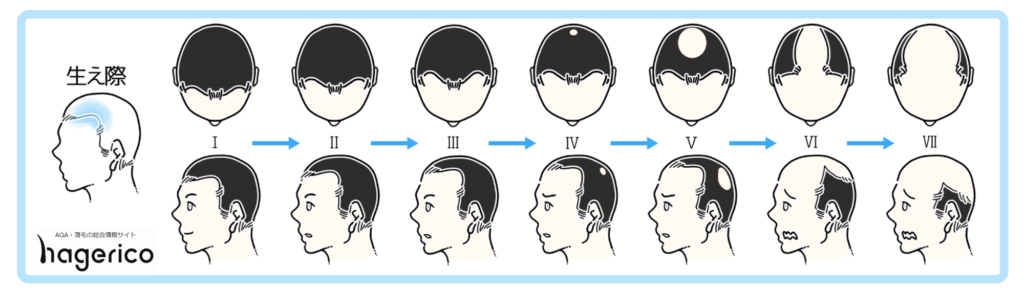 生え際 M字ハゲ AGA 薄毛