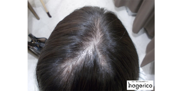 女性のつむじハゲを治す方法は 頭頂部の薄毛を治す対策法と原因を解説 Hagerico スーパースカルプ発毛センター